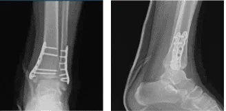 Radiografía del tobillo izquierdo completada 3 o más visitas 1 semana después de la operación