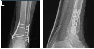 Radiografía del tobillo izquierdo completada 3 o más visitas-4 semanas después de la operación