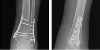 Radiografía del tobillo izquierdo completada 3 o más visitas a las 16 semanas postoperatorias