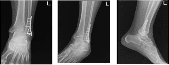 Left ankle X-ray complete 3 (2)