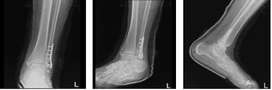 Radiografía del tobillo izquierdo completada