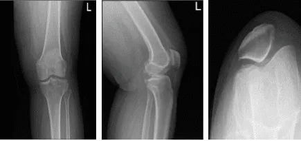 Left knee x-ray complete with patella