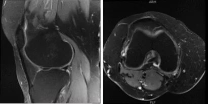 MRI-3T Knee non-contrast