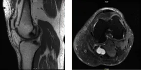MRI-3T Left knee non-contrast