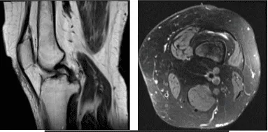 MRI-3T Left knee non-contrast