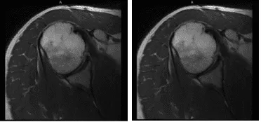 MRI-3T Hombro derecho sin contraste  