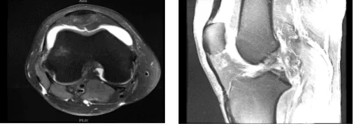 MRI-3T Right knee non-contrast