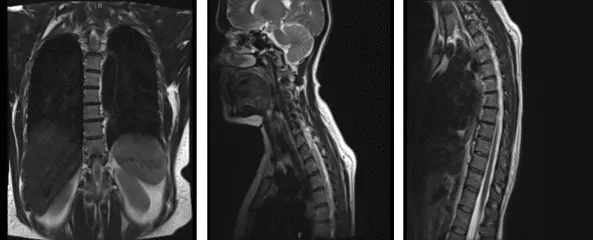 MRI-3T Columna torácica sin contraste