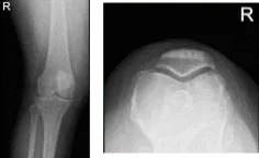 MRI-3T right knee non-contrast