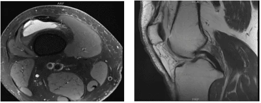 MRI-3T right knee non-contrast