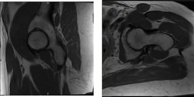 Resonancia magnética Sin contraste en la cadera izquierda