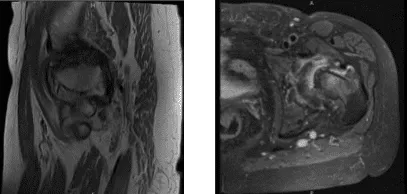 MRI Left hip non-contrast