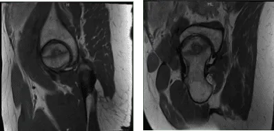 Resonancia magnética Sin contraste en la cadera derecha
