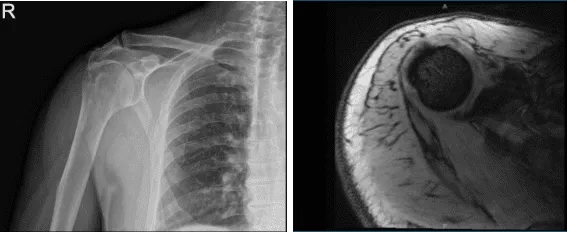 Resonancia magnética Radiografía del hombro derecho