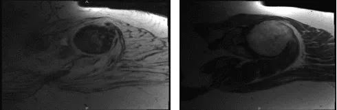 Primer resultado de la resonancia magnética