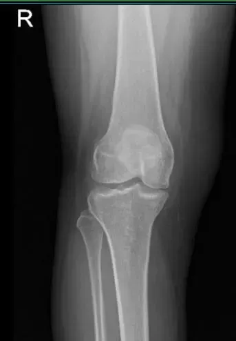 MRI of right knee