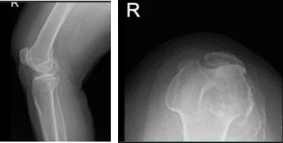 Resonancia magnética de la rodilla derecha