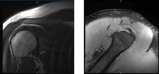 MRI of right shoulder