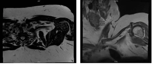 Segundo resultado de la resonancia magnética