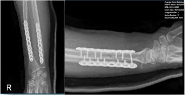 Right Forearm X-ray-1st week post-operative