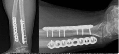 Right Forearm X-ray-32nd week post-operative