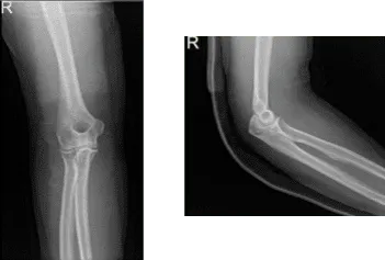 Radiografía del codo derecho