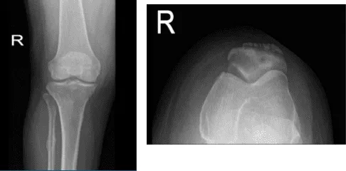Right knee X-ray AP and Lateral