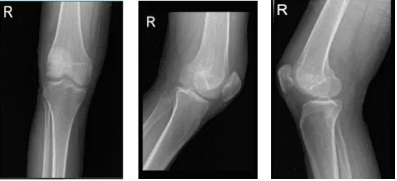 Rayos X de rodilla derecha, vistas AP laterales y oblicuas 3