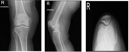 Radiografía de rodilla derecha con rótula