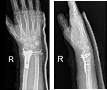 Right wrist X-ray 3 or more views-4th week post operative