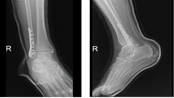 X-ray right ankle - 3 weeks after surgery