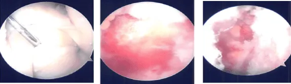 MRI of the right knee