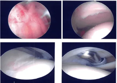 Intraoperative Arthroscopy Images