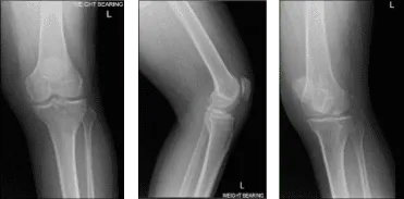 Resonancia magnética de rodilla izquierda