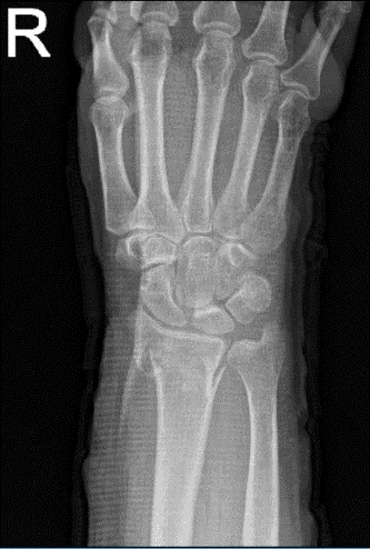 Radiografía de la muñeca derecha 3 o más vistas