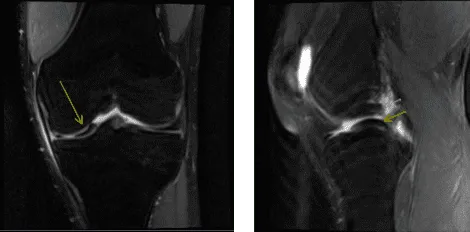 MRI of left knee