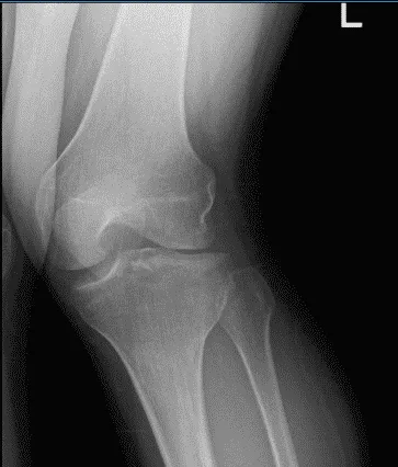 Radiografía de rodilla izquierda y radiografía lateral con vistas oblicuas 3