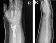 Right wrist x-ray 3 or more views