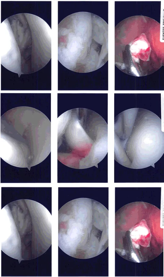 Intraoperative Arthroscopy Images