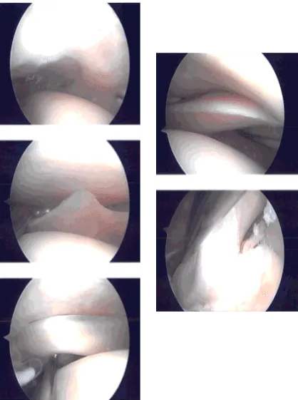 Intraoperative Arthroscopy Images