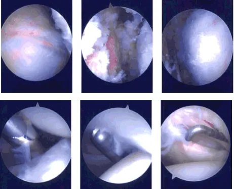 Imágenes de artroscopia intraoperatoria