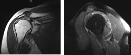MRI right shoulder non-contrast