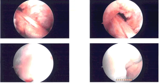 Intraoperative Arthroscopy Images