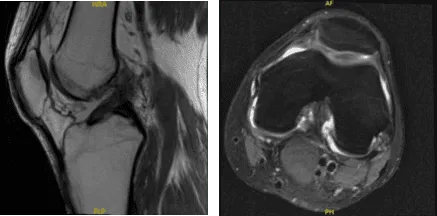 MRI-3T Rodilla izquierda sin contraste