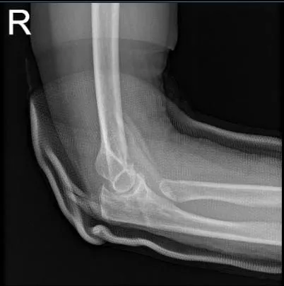 Rayos X de la muñeca derecha 3 o más vistas