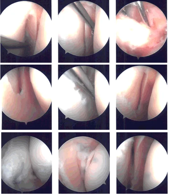Intraoperative Arthroscopy Images