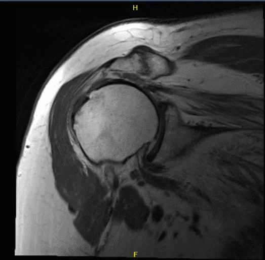 MRI-3T right shoulder non-contrast