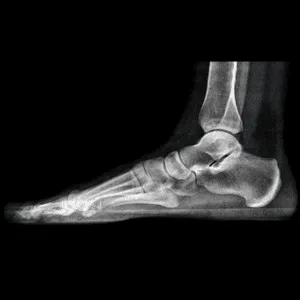 Foot Xray