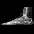foot xray