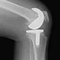 Knee Xray